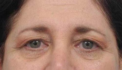 Eyelid Surgery Before Photo | Miami, FL | Baker Plastic Surgery