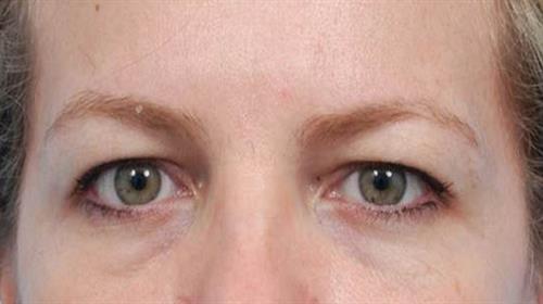 Eyelid Surgery Before Photo | Miami, FL | Baker Plastic Surgery