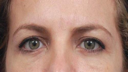 Eyelid Surgery After Photo | Miami, FL | Baker Plastic Surgery