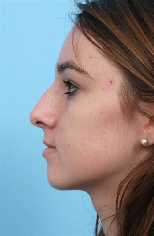 Rhinoplasty Before Photo | Miami, FL | Baker Plastic Surgery