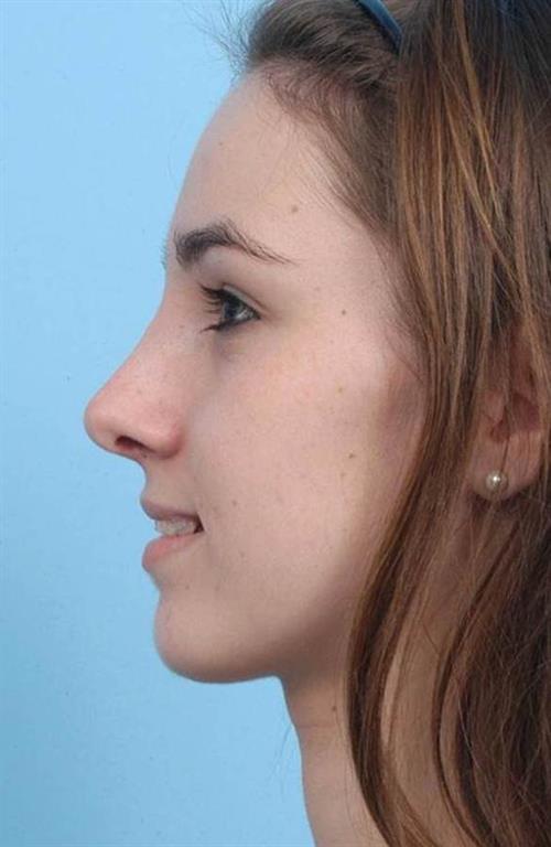 Rhinoplasty After Photo | Miami, FL | Baker Plastic Surgery