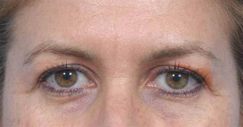 Eyelid Surgery Before Photo | Miami, FL | Baker Plastic Surgery