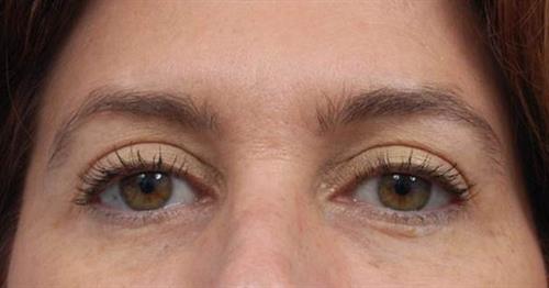 Eyelid Surgery After Photo | Miami, FL | Baker Plastic Surgery