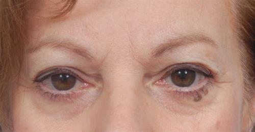 Eyelid Surgery Before Photo | Miami, FL | Baker Plastic Surgery