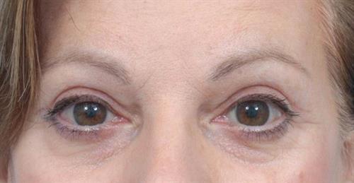 Eyelid Surgery After Photo | Miami, FL | Baker Plastic Surgery