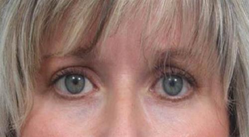 Eyelid Surgery After Photo | Miami, FL | Baker Plastic Surgery