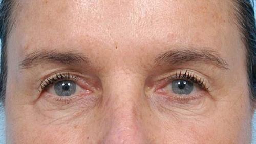 Eyelid Surgery Before Photo | Miami, FL | Baker Plastic Surgery