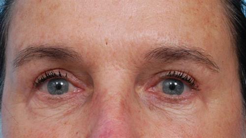 Eyelid Surgery After Photo | Miami, FL | Baker Plastic Surgery