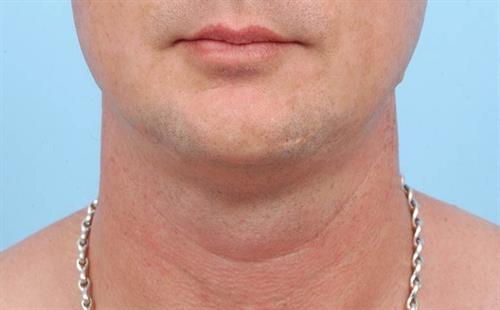 Submental Liposuction After Photo | Miami, FL | Baker Plastic Surgery