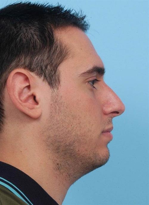 Rhinoplasty Before Photo | Miami, FL | Baker Plastic Surgery