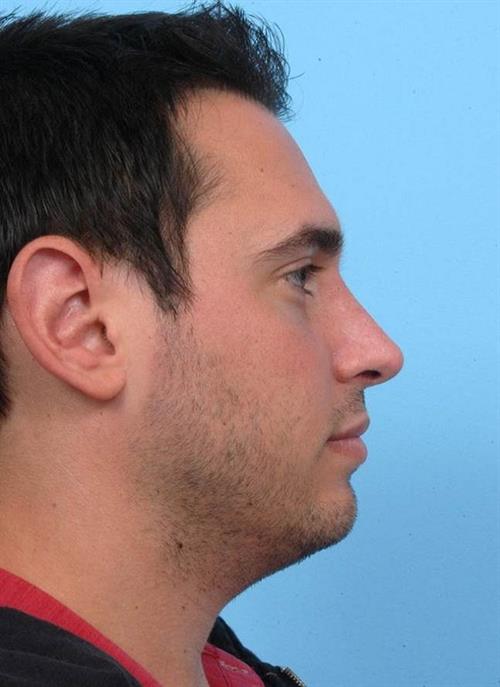 Rhinoplasty After Photo | Miami, FL | Baker Plastic Surgery