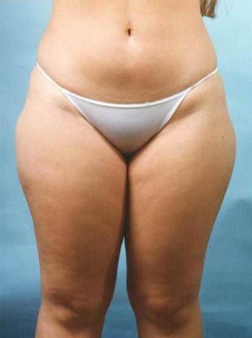 Liposuction Before Photo | Miami, FL | Baker Plastic Surgery