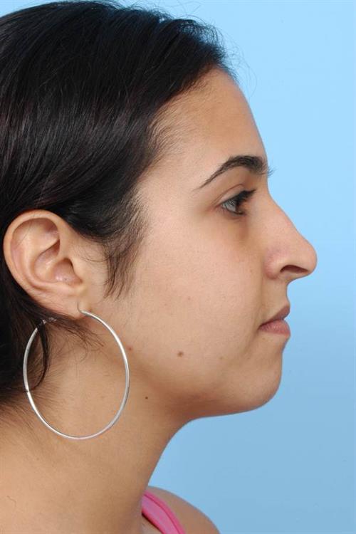 Rhinoplasty Before Photo | Miami, FL | Baker Plastic Surgery