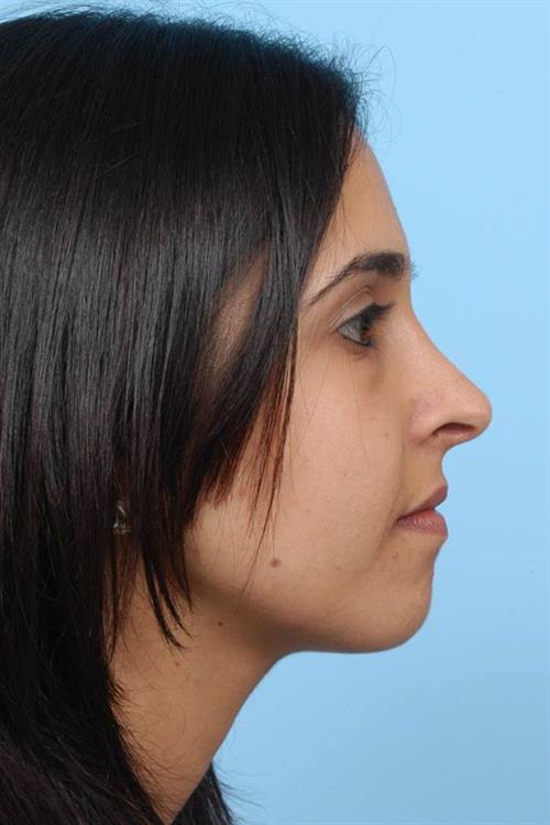 Rhinoplasty After Photo | Miami, FL | Baker Plastic Surgery