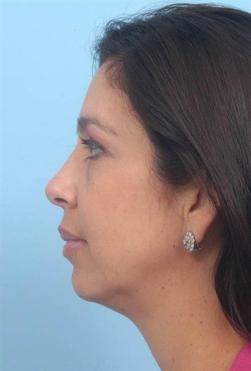 Rhinoplasty After Photo | Miami, FL | Baker Plastic Surgery