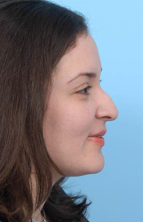 Rhinoplasty Before Photo | Miami, FL | Baker Plastic Surgery