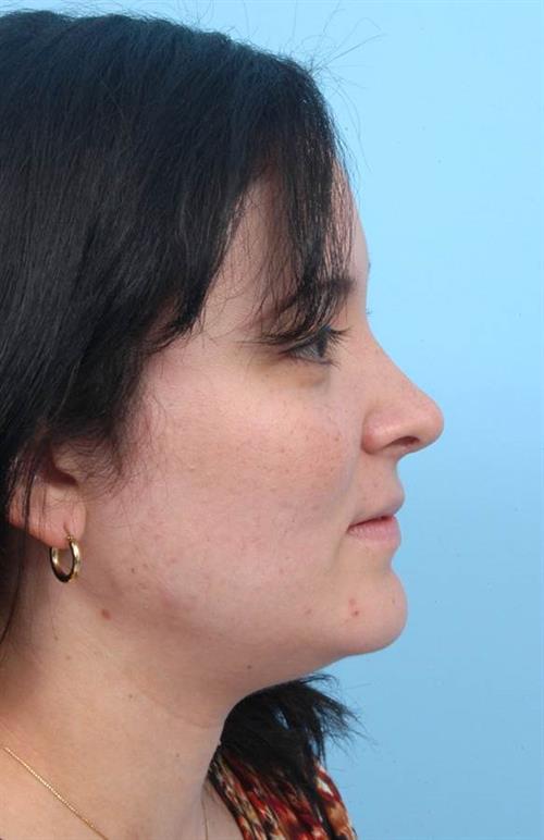 Rhinoplasty After Photo | Miami, FL | Baker Plastic Surgery