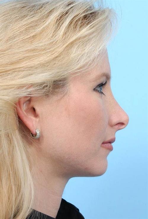 Rhinoplasty Before Photo | Miami, FL | Baker Plastic Surgery