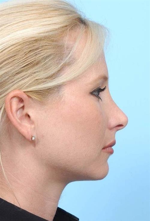 Rhinoplasty After Photo | Miami, FL | Baker Plastic Surgery