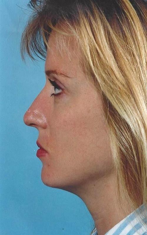 Rhinoplasty Before Photo | Miami, FL | Baker Plastic Surgery