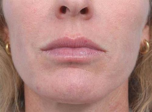 Lip Augmentation After Photo | Miami, FL | Baker Plastic Surgery
