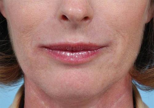 Lip Augmentation After Photo | Miami, FL | Baker Plastic Surgery