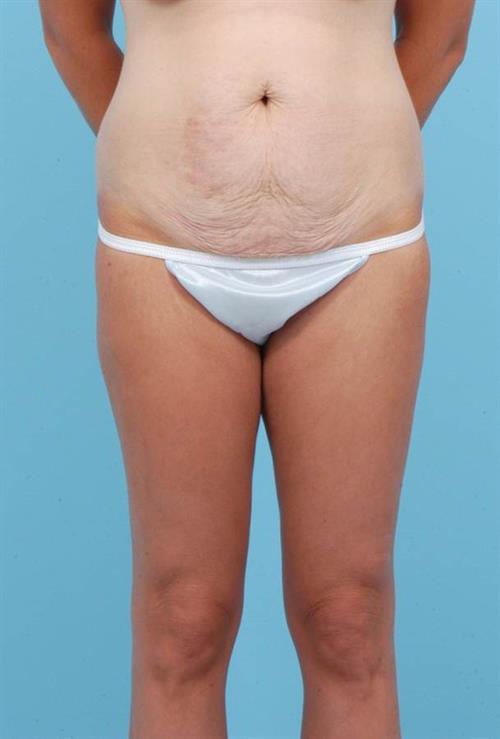 Tummy Tuck Before Photo | Miami, FL | Baker Plastic Surgery