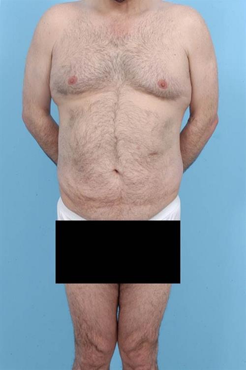 Tummy Tuck Before Photo | Miami, FL | Baker Plastic Surgery