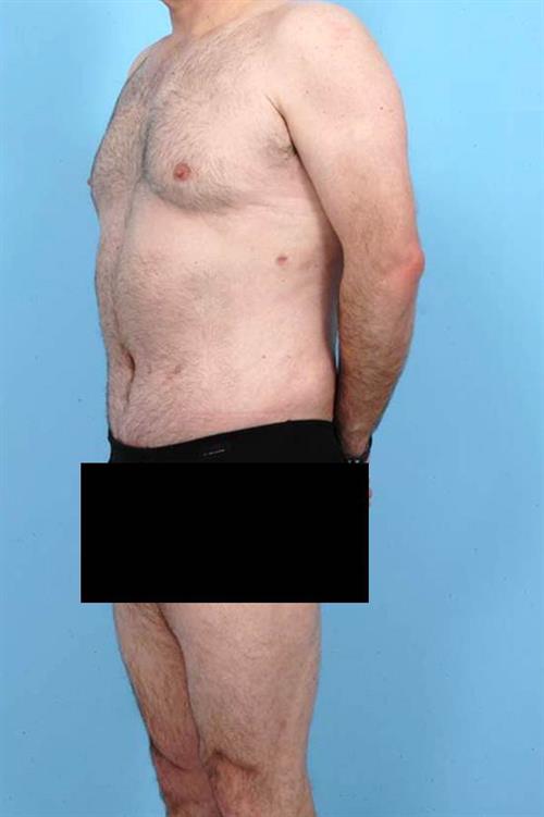 Tummy Tuck After Photo | Miami, FL | Baker Plastic Surgery