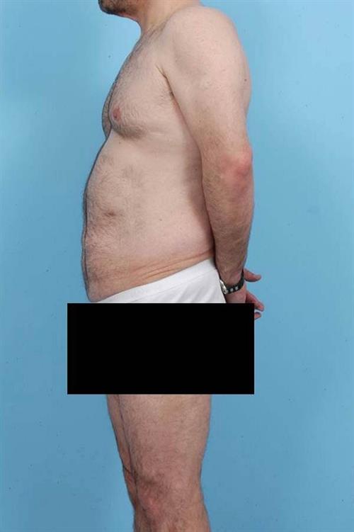 Tummy Tuck Before Photo | Miami, FL | Baker Plastic Surgery