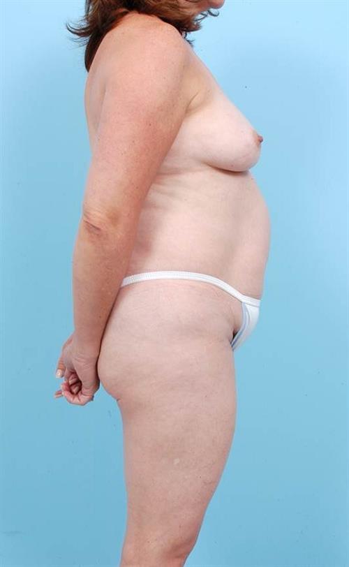 Tummy Tuck Before Photo | Miami, FL | Baker Plastic Surgery