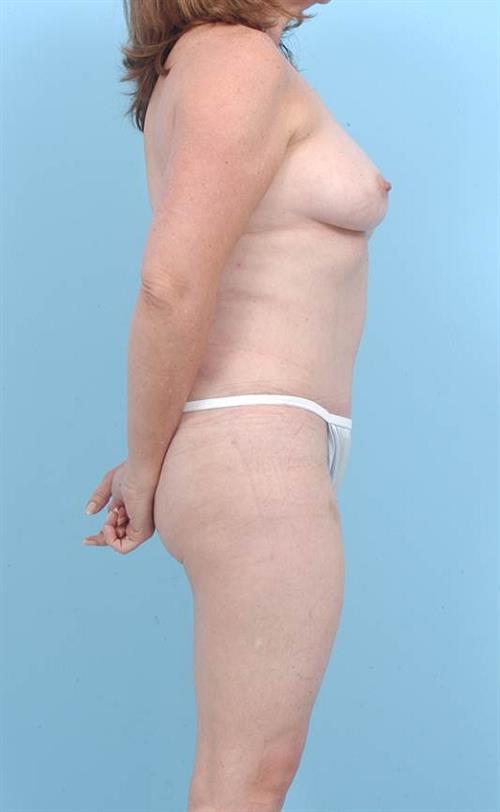 Tummy Tuck After Photo | Miami, FL | Baker Plastic Surgery