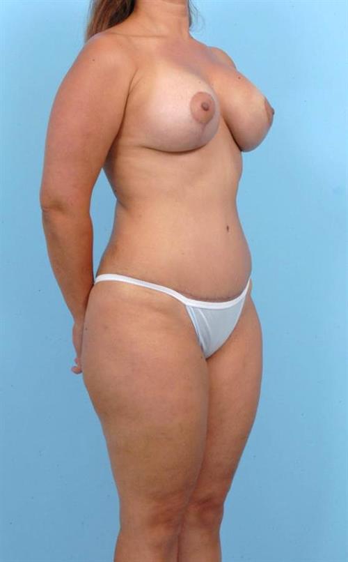 Tummy Tuck After Photo | Miami, FL | Baker Plastic Surgery