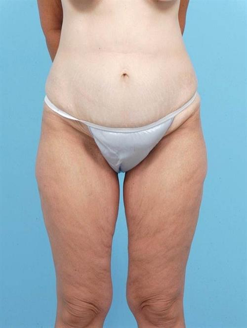 Tummy Tuck Before Photo | Miami, FL | Baker Plastic Surgery