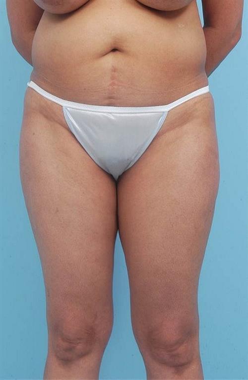 Tummy Tuck Before Photo | Miami, FL | Baker Plastic Surgery