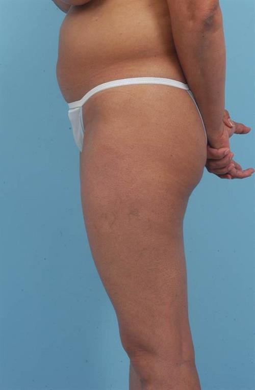 Tummy Tuck Before Photo | Miami, FL | Baker Plastic Surgery