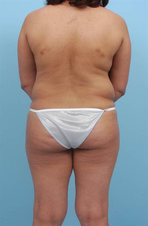 Tummy Tuck Before Photo | Miami, FL | Baker Plastic Surgery