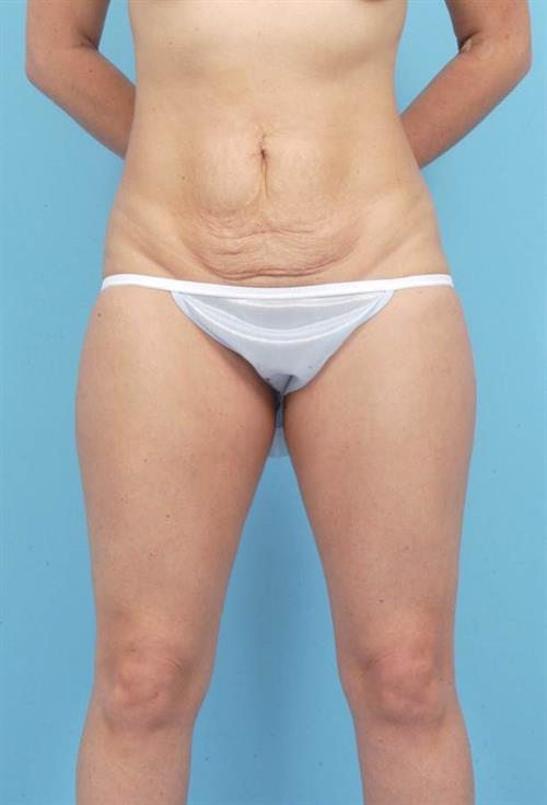 Tummy Tuck Before Photo | Miami, FL | Baker Plastic Surgery