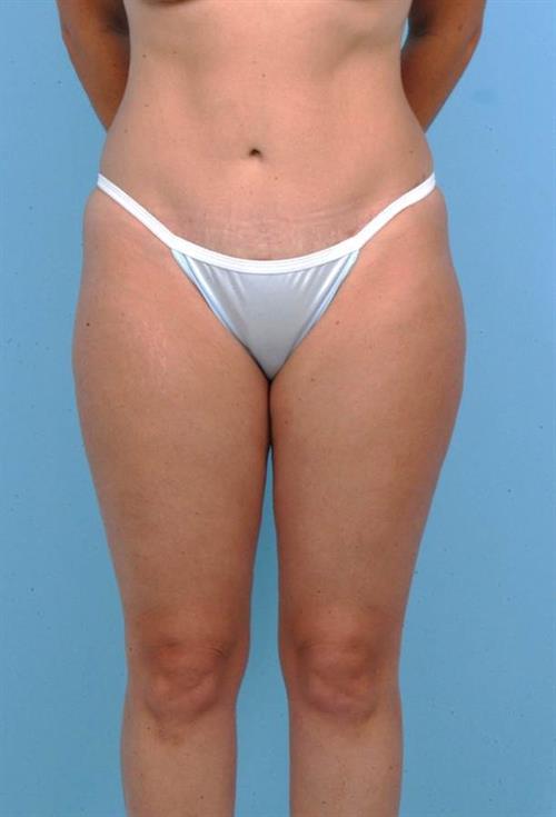 Tummy Tuck After Photo | Miami, FL | Baker Plastic Surgery