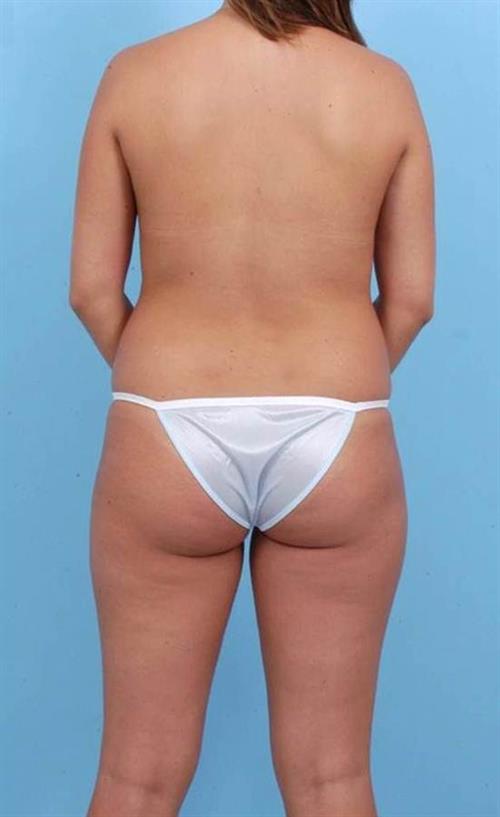 Liposuction Before Photo | Miami, FL | Baker Plastic Surgery