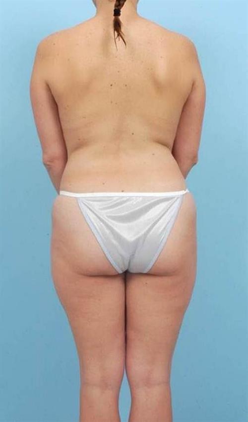 Liposuction Before Photo | Miami, FL | Baker Plastic Surgery