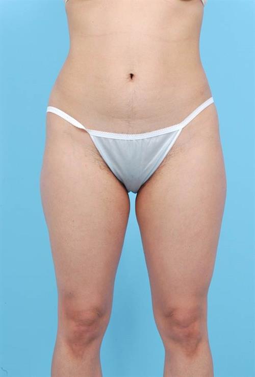 Liposuction Before Photo | Miami, FL | Baker Plastic Surgery