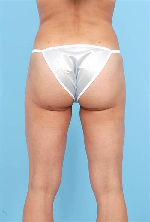 Liposuction After Photo | Miami, FL | Baker Plastic Surgery