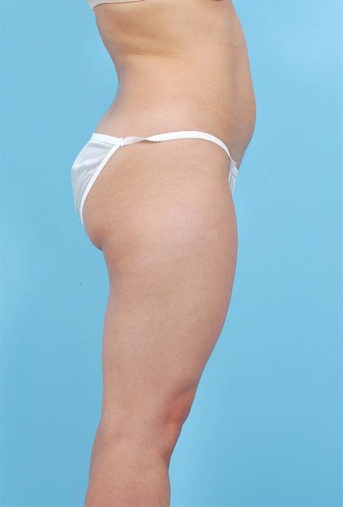 Liposuction Before Photo | Miami, FL | Baker Plastic Surgery