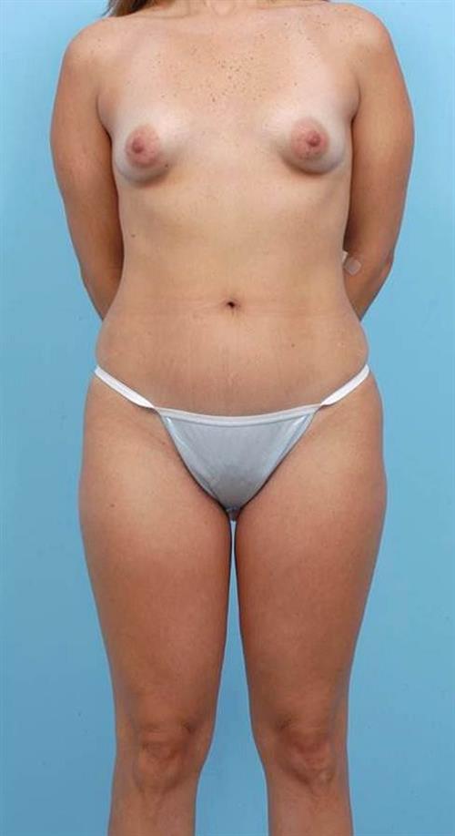 Liposuction Before Photo | Miami, FL | Baker Plastic Surgery