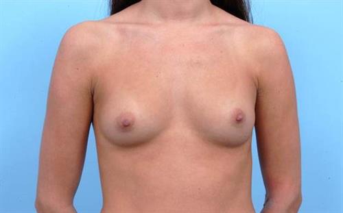 Breast Augmentation Before Photo | Miami, FL | Baker Plastic Surgery