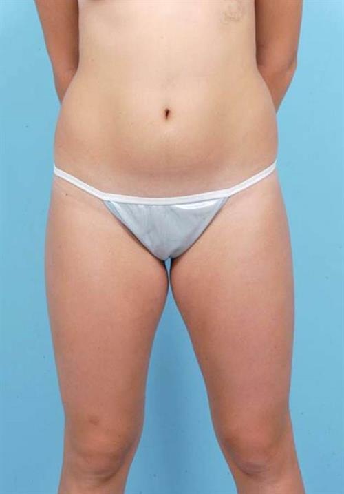 Liposuction Before Photo | Miami, FL | Baker Plastic Surgery