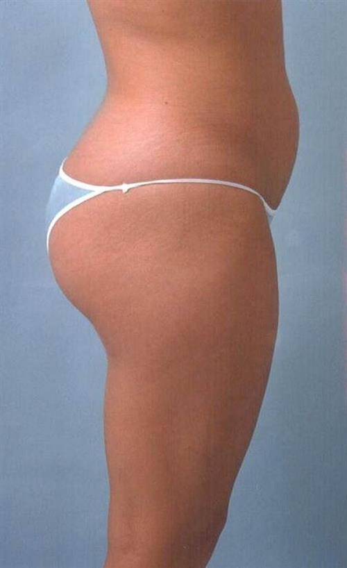 Liposuction Before Photo | Miami, FL | Baker Plastic Surgery