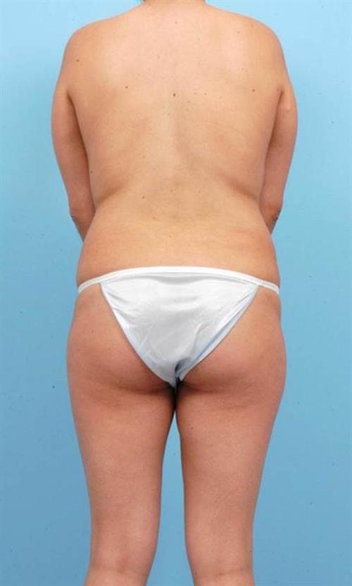 Liposuction Before Photo | Miami, FL | Baker Plastic Surgery