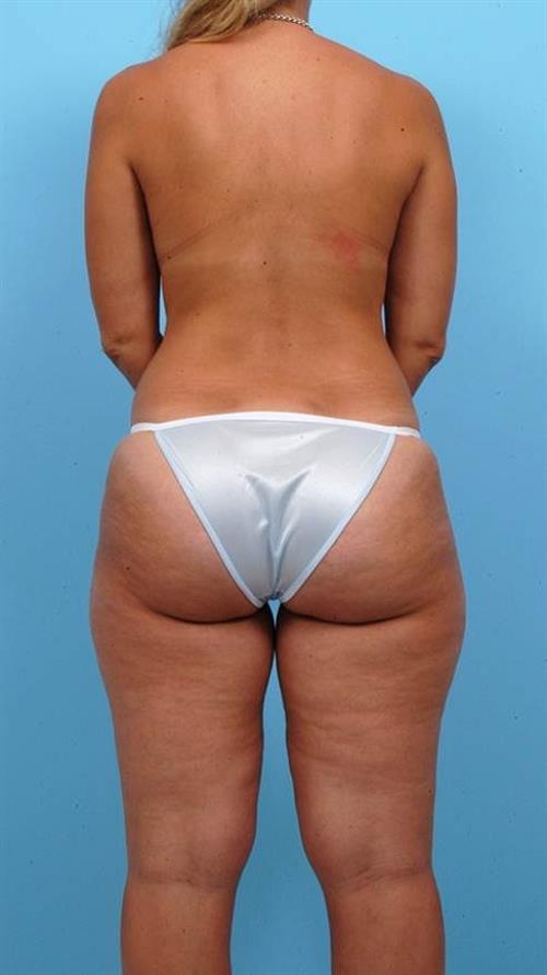 Liposuction Before Photo | Miami, FL | Baker Plastic Surgery